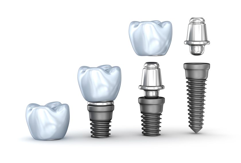 インプラントに関するよくある質問